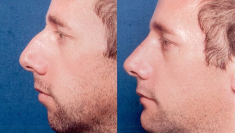 The Authenticity And Popularity Of Chin Surgery In Men