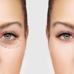 Everything You Need To Know About Eye Bag Surgery!