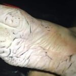 Is trench foot a fungal infection?