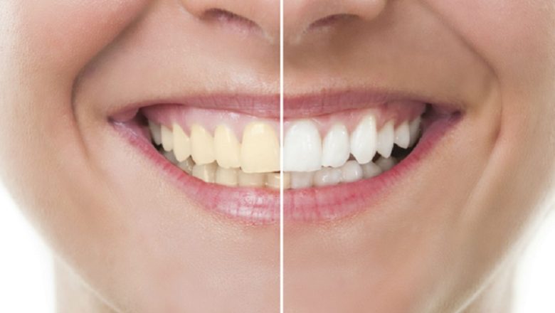 What Are Teeth Whitening Results?