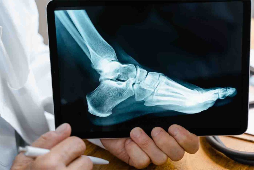 Achilles Tendonitis Treatment in Ontario