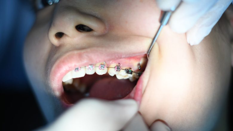 Bite Alignment Beyond Braces: The Role of Orthodontics in Lifelong Oral Health