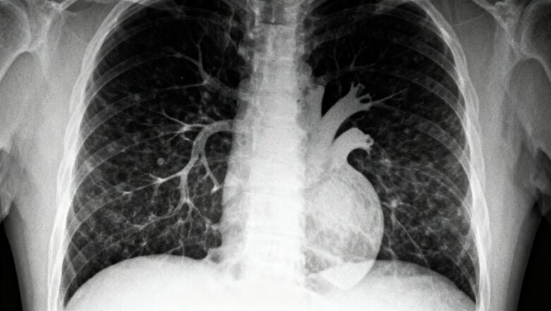 Understanding Asbestos Lung Cancer