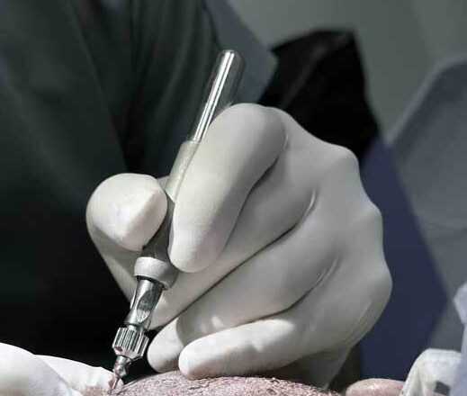 DHI Hair Transplant in Turkey: Technique, Candidates and What to Expect
